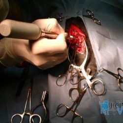 Samotný operační přístup se provádí ze strany vedle hřbetních výběžků páteře. Musí být odstraněna kostní tkáň příslušných obratlů a vyjmuta tkáň postižených meziobratlových plotének.