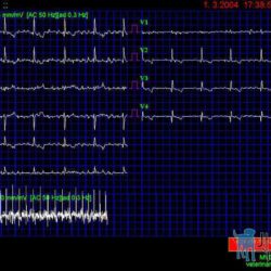 Obr.1 ( EKG 1) – Fibrilace síní patrná ve všech svodech.
