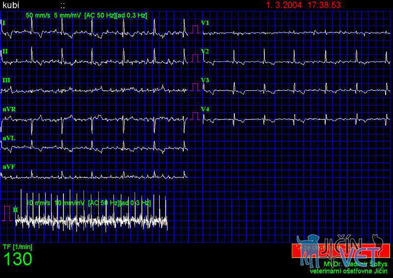 Obr.1 ( EKG 1) – Fibrilace síní patrná ve všech svodech.