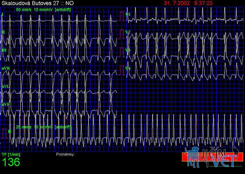 Obr.2 ( EGG 7) – EKG záznam u pacienta s dilatačni kardiomyopatií a srdečním selháním NYHA III. Komplexy QRS deformované, fibrilace síní je proto patrná pouze ve svodu V1 (C1).