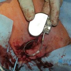 Implantace karidostimulátoru. Elektrody jsou skrze cévy zavedeny do srdeční síně.