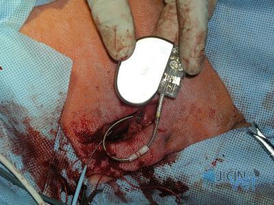 Implantace karidostimulátoru. Elektrody jsou skrze cévy zavedeny do srdeční síně.