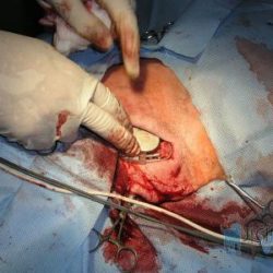 Kardiostimulátor je uložen v kožní kapse