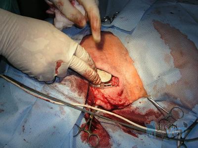 Kardiostimulátor je uložen v kožní kapse