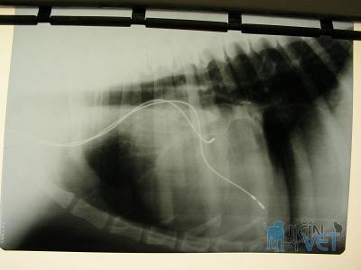 Rentgenový snímek elektrod kardiostimulátoru uchycených v srdci